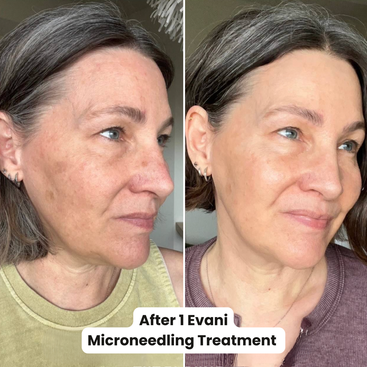 M8 Microneedling Pen Beginners Bundle