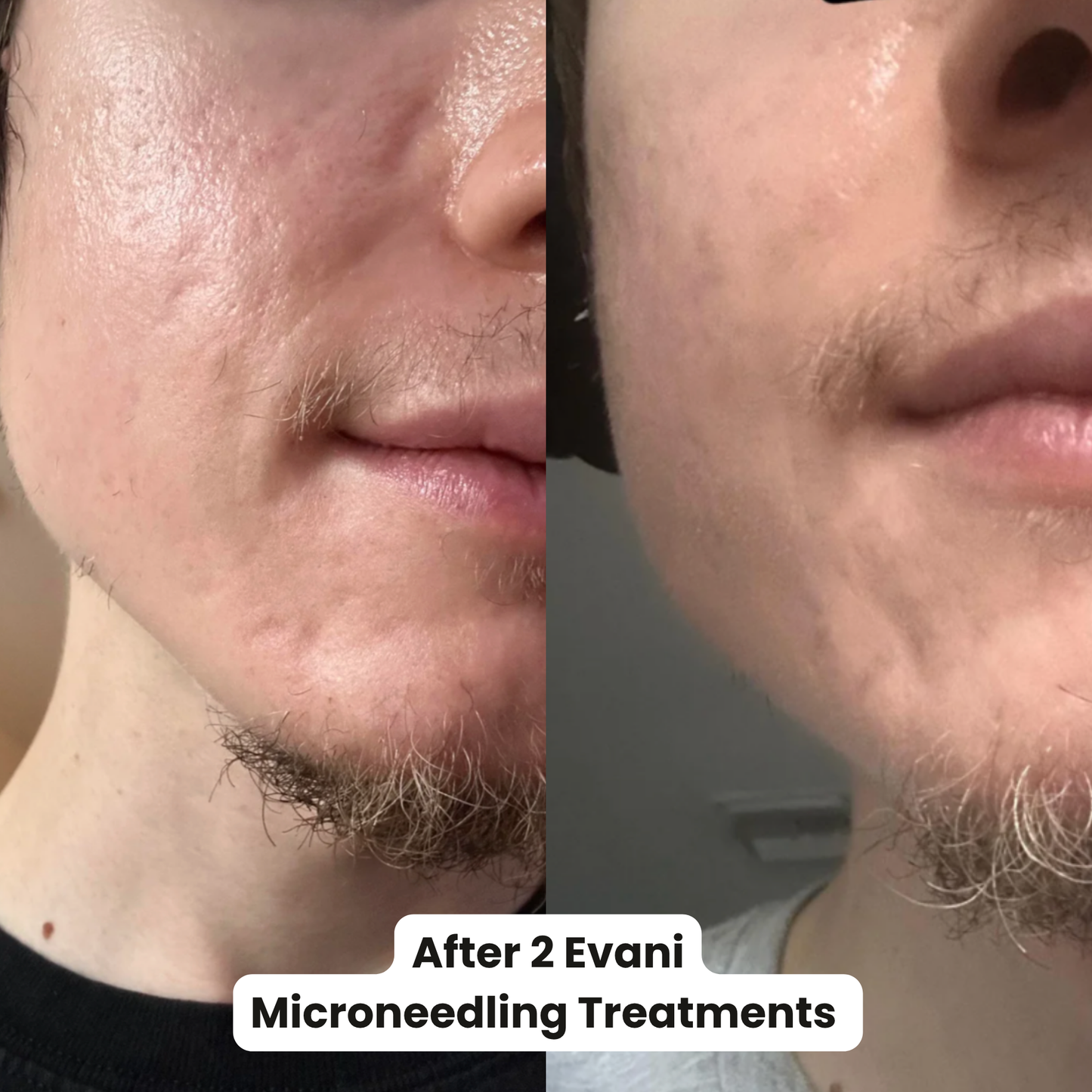 M8S Microneedling Pen
