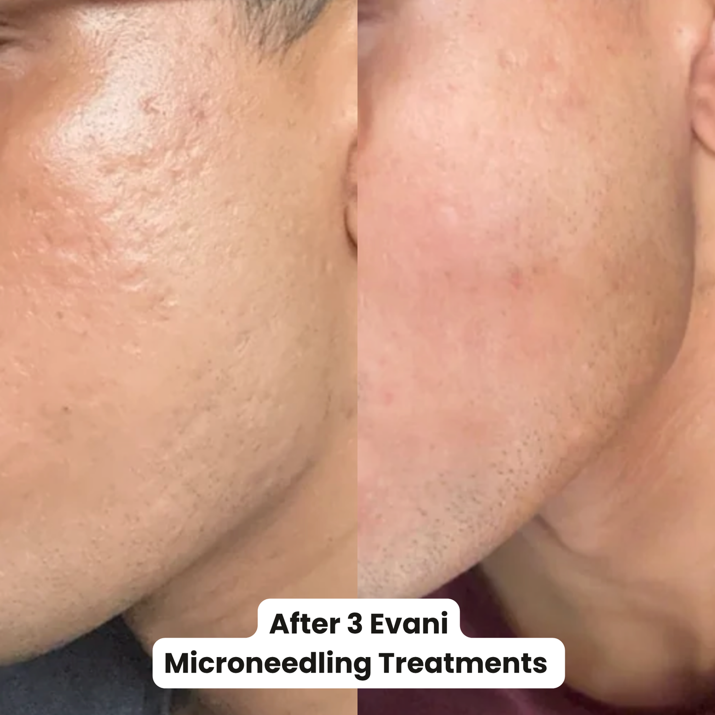M8 Microneedling Pen