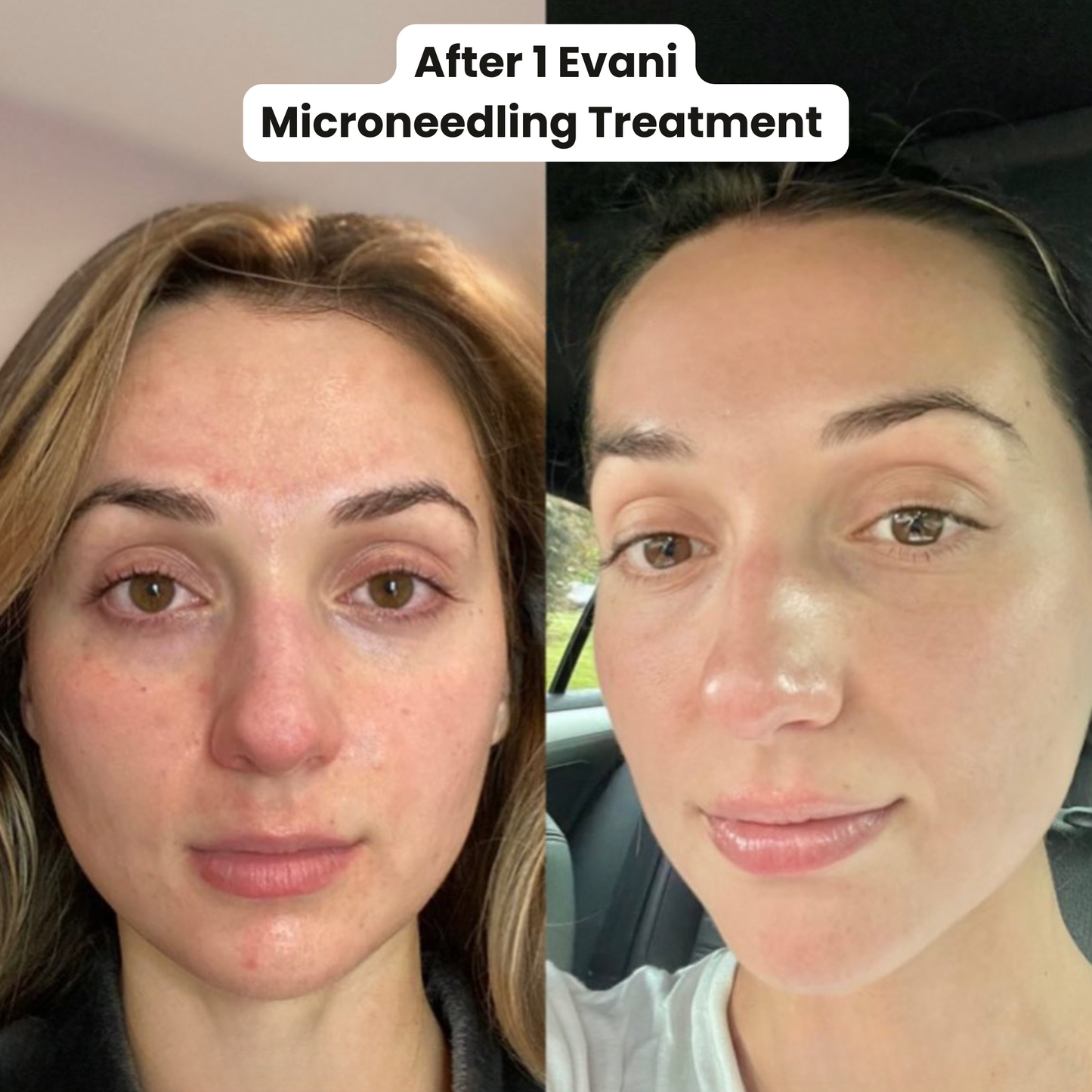 M8 Microneedling Pen Beginners Bundle