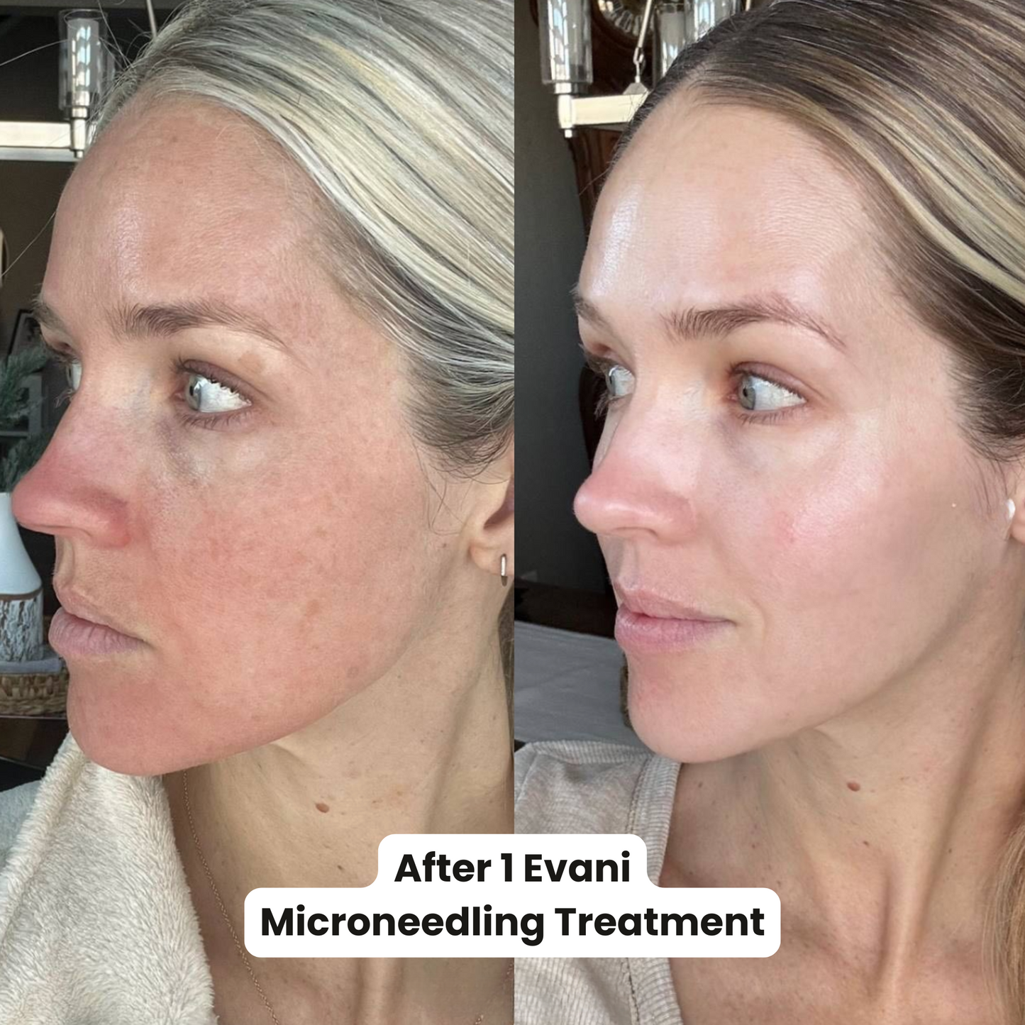 M8 Microneedling Pen Beginners Bundle