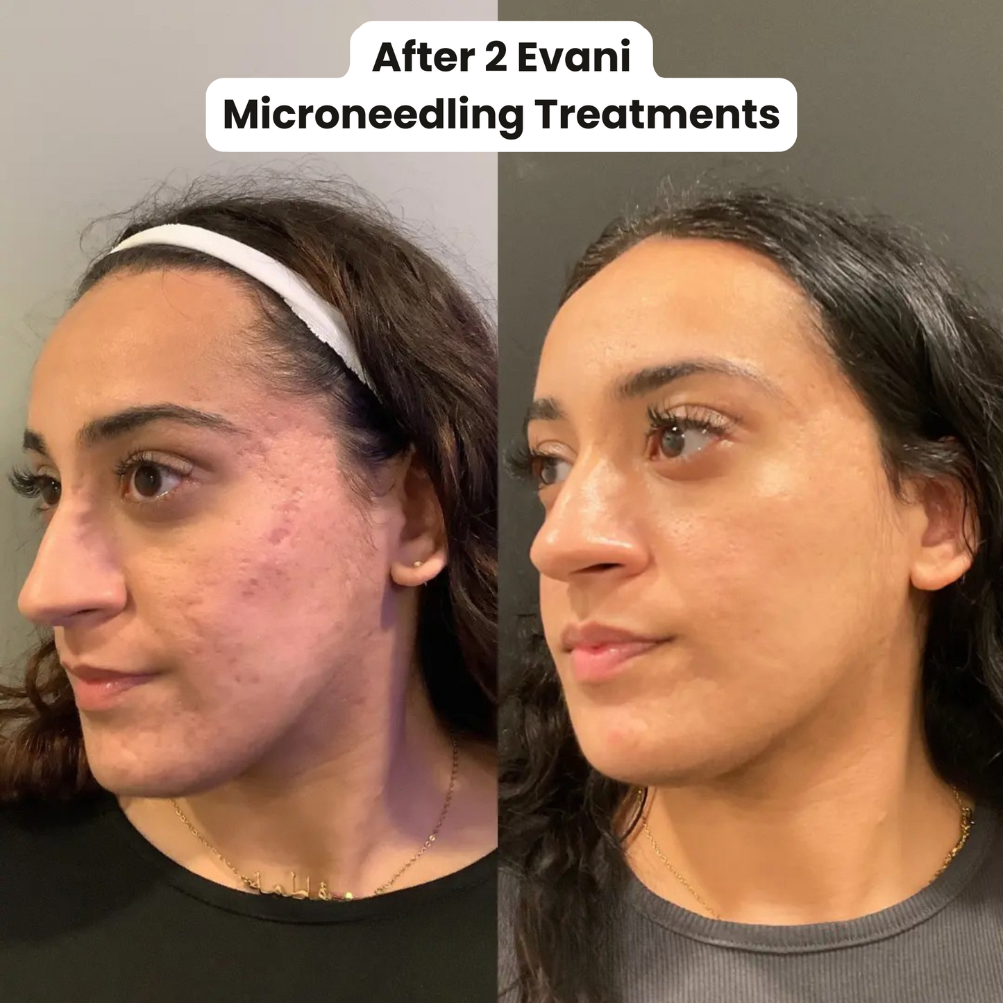 M8 Microneedling Pen