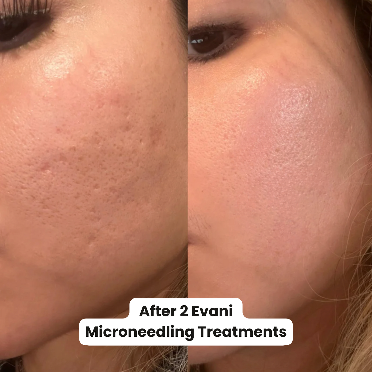M8 Microneedling Pen