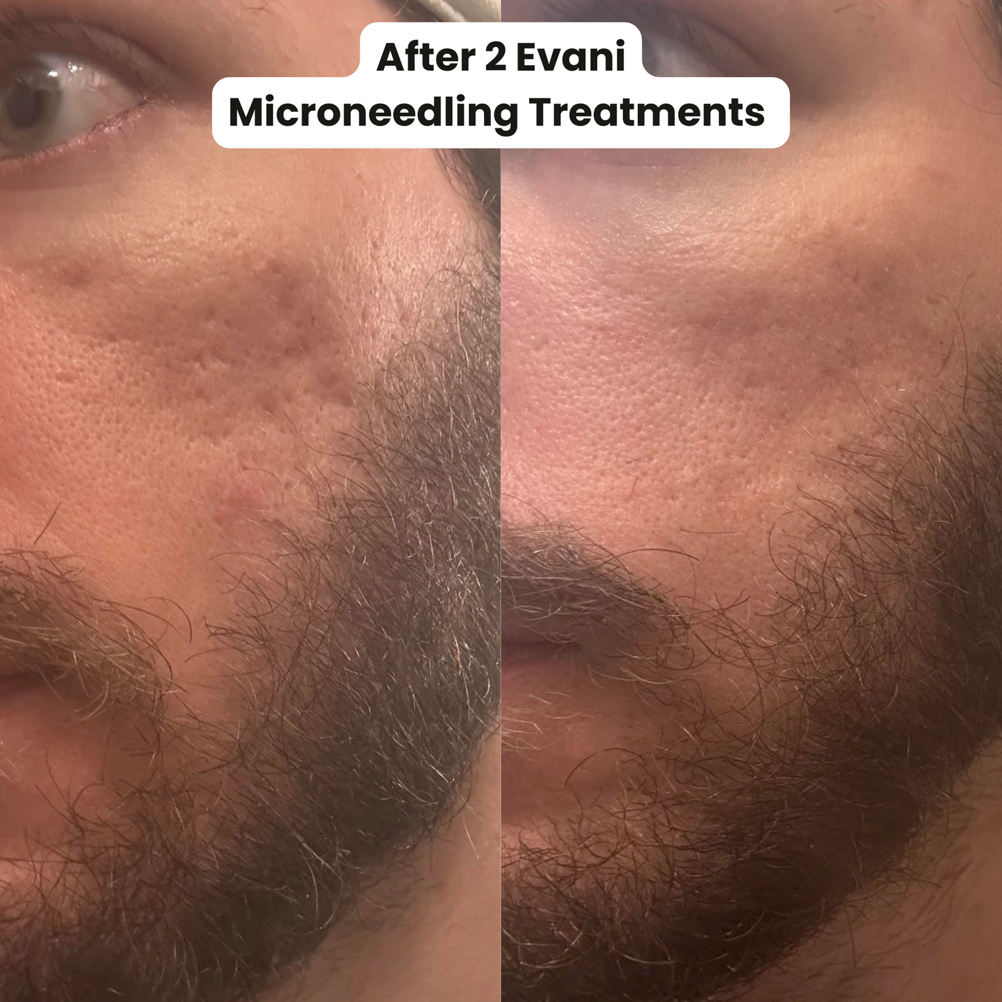 M8S Microneedling Pen