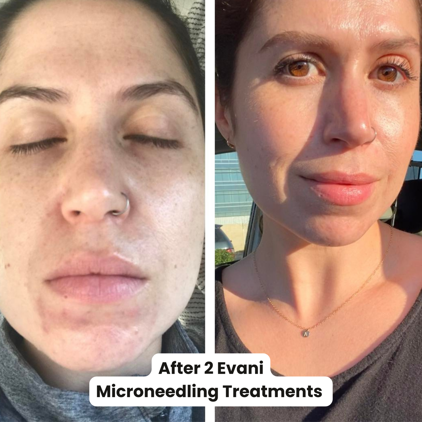 M8 Microneedling Pen Beginners Bundle