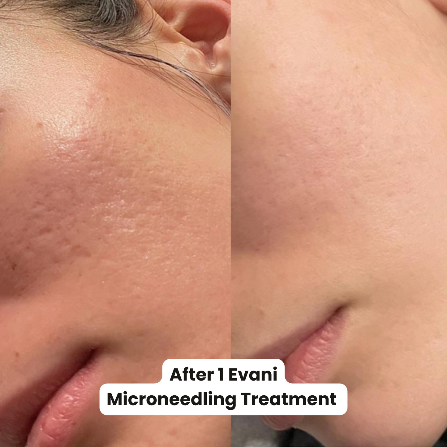 M8 Microneedling Pen