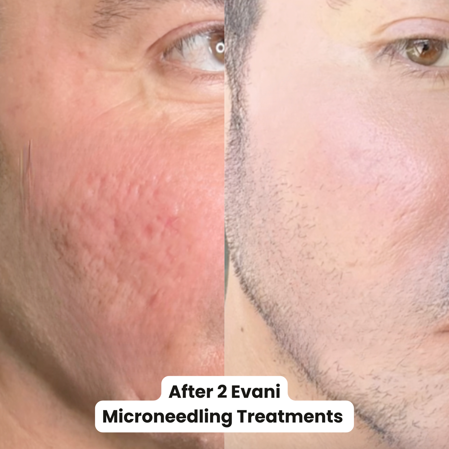 M8 Microneedling Pen