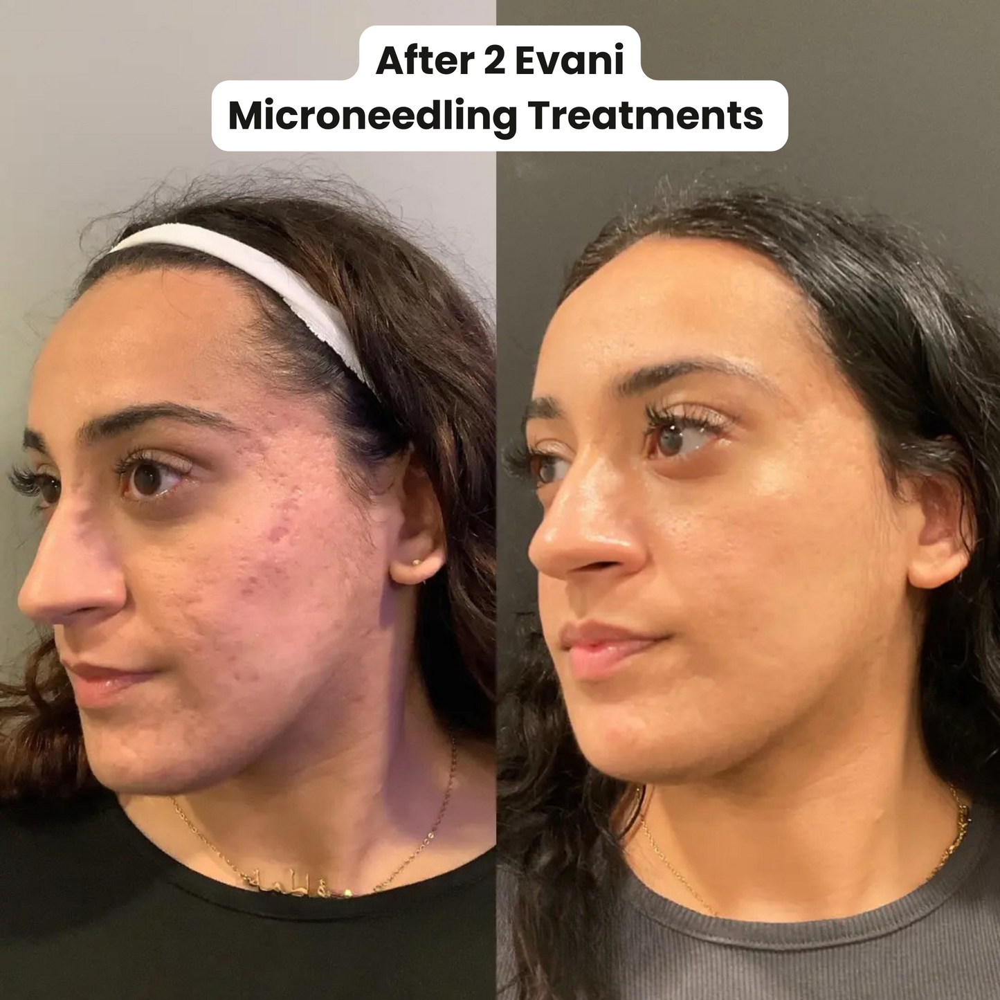 Evani DermaPro Microneedling Pen