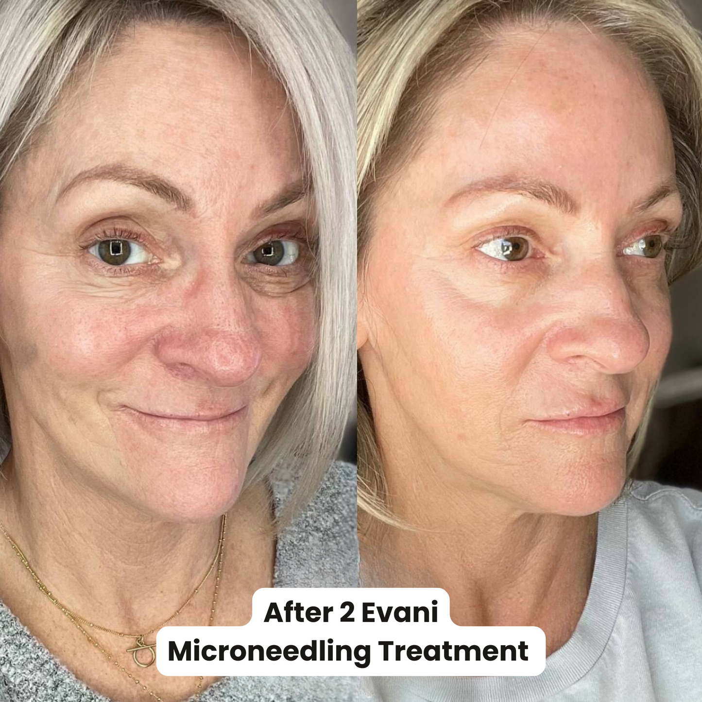 M8 Microneedling Pen Beginners Bundle