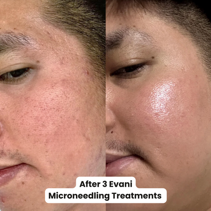 M8 Microneedling Pen